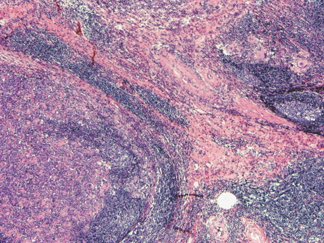 Figura 6. Zona con reaccin histioctica y de clulas gigantes multinucleadas (izquierda y arriba a la derecha)con infiltrado mononuclear y formacin de folculo linfoide.